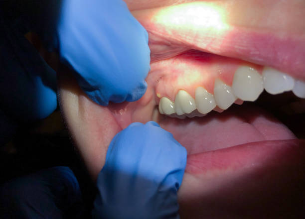 Best Emergency Treatment for Toothache in Stone Ridge, NY